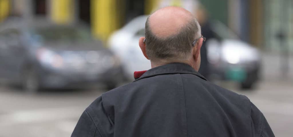 Come superare la paura di perdere i capelli - Psichiatra Roma